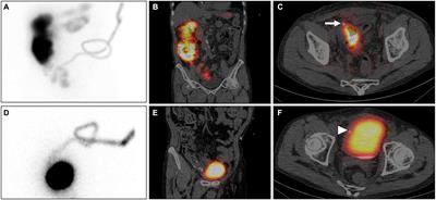 Confirmation of intestinal and bladder perforations in a peritoneal dialysis patient using SPECT/CT: a case report and review of literature